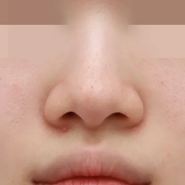 코 아래쪽과 중안면이 눌려 보여 얼굴 중심부가 평면적으로 보이는 경우