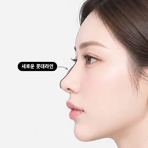 매부리 위아래가 상대적으로 낮아 콧대가 울퉁불퉁해 보이는 경우