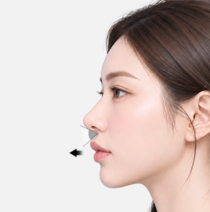 비순각이 좁고 인중이 뒤로 누워 있어 입이 상대적으로 돌출되어 보이는 경우
