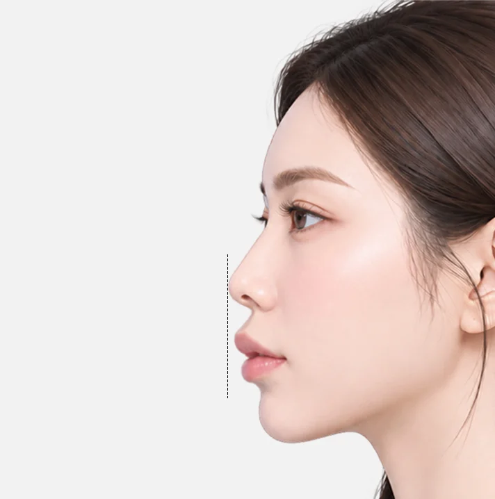 치아나 잇몸뼈의 돌출보다 중안면과 코·입술의 구조 때문에 입이 나와 보이는 경우