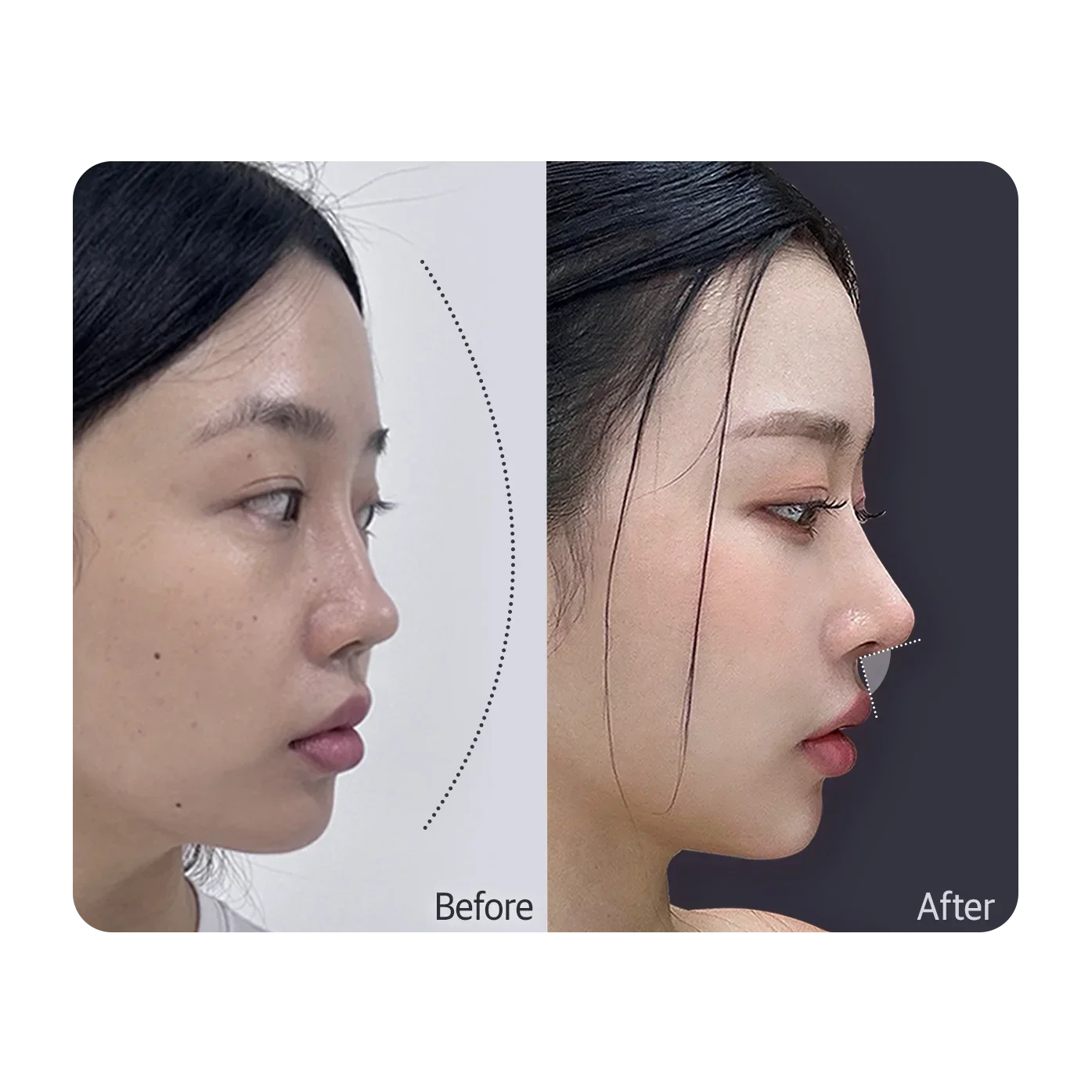 일반 코성형과 비순각코성형의 코끝·비주·인중 측면 라인 비교