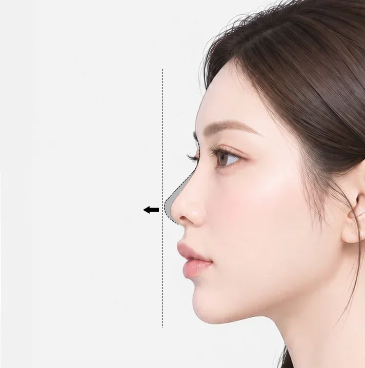 비순각이 좁고 인중이 뒤로 누워 있어 입이 상대적으로 돌출되어 보이는 경우