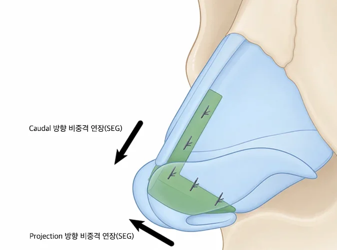 일반 코성형과 비순각코성형의 코끝·비주·인중 측면 라인 비교