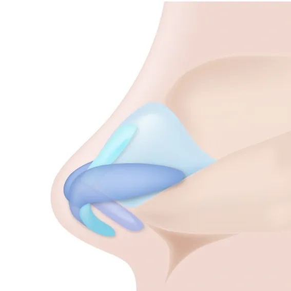 비중격연장이식으로 코끝 위치를 조절하는 구조 모식도