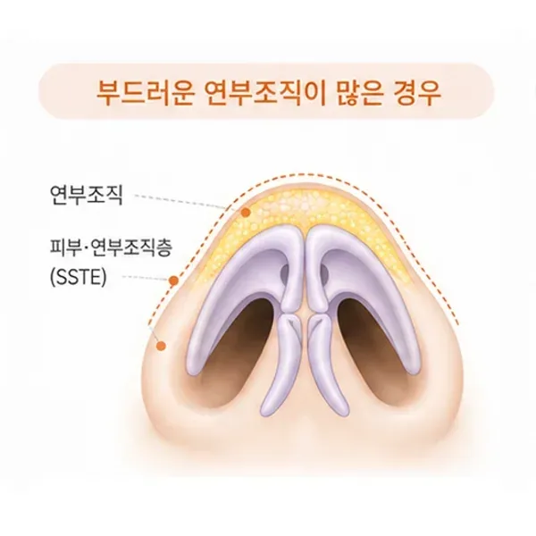 부드러운 연부조직이 많은 복코의 구조
