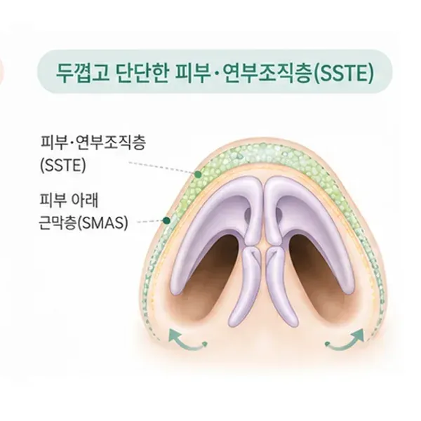 두껍고 단단한 피부와 연부조직층으로 코끝이 커 보이는 경우