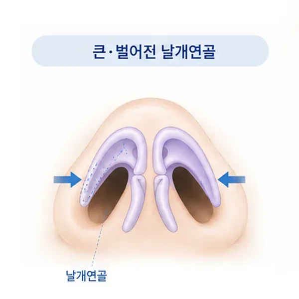 큰 날개연골이 벌어져 코끝이 넓어 보이는 경우
