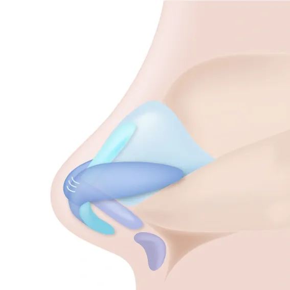 코끝연골 고정과 추가 비주연골이식의 구조 모식도